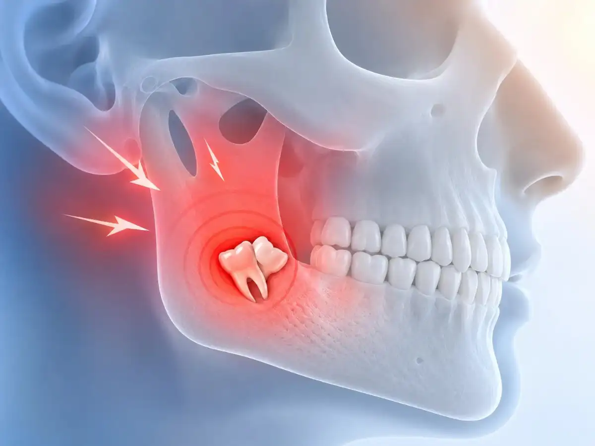 Jaw pain caused by wisdom tooth Gurgaon