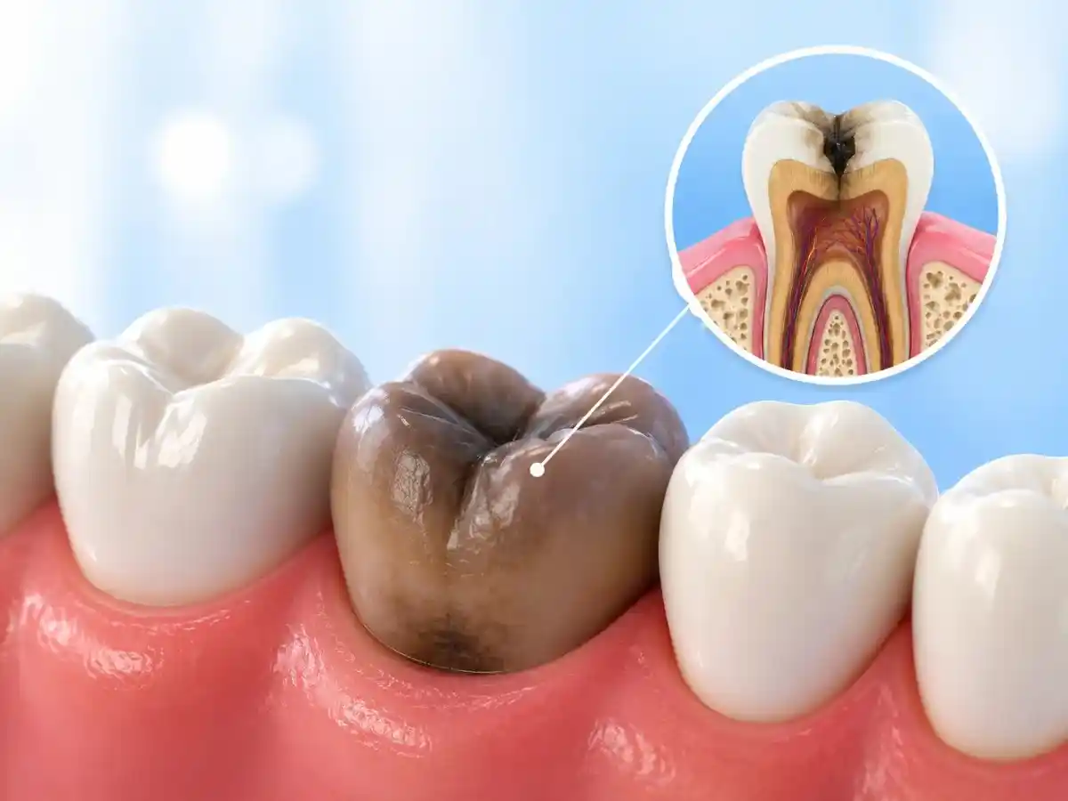 Tooth turning darker root canal Gurgaon