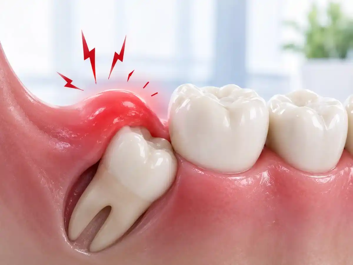 Wisdom tooth swelling symptoms Gurgaon