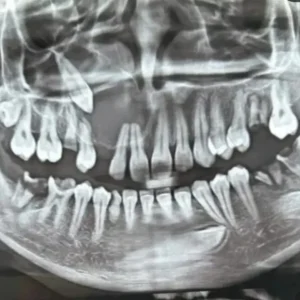 teeth xray