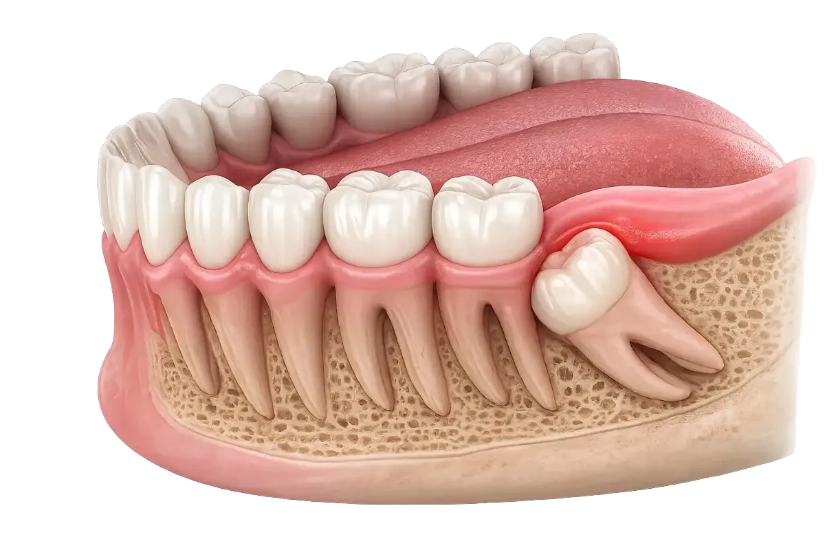 wisdom tooth extraction in gurgaon