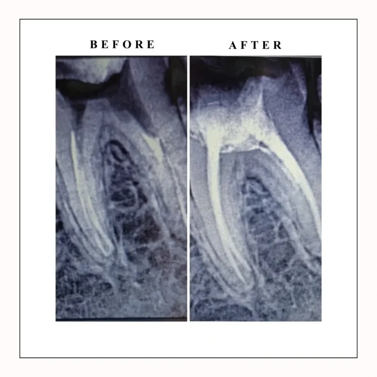 root canal treatment near me