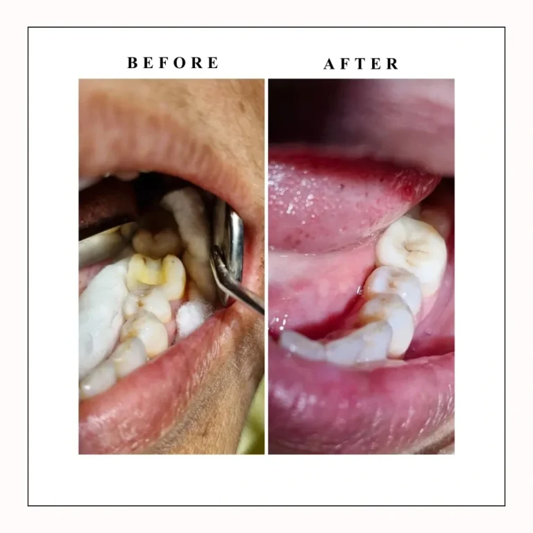 root canal treatment