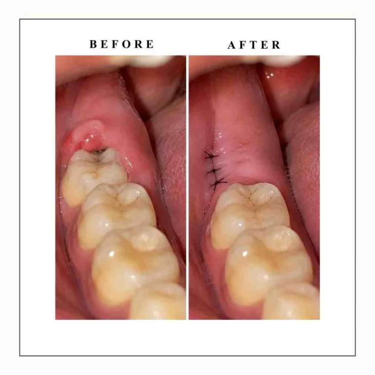 WisdomToothPain