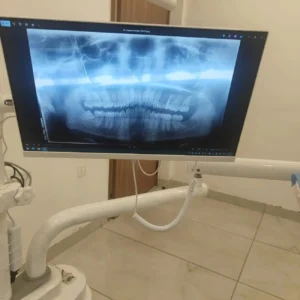 wisdom tooth extraction