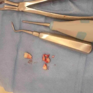 wisdom tooth extraction