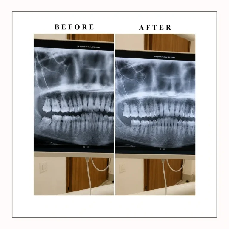 wisdom tooth after before