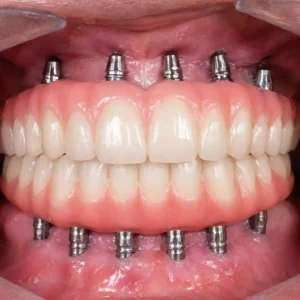Full Mouth