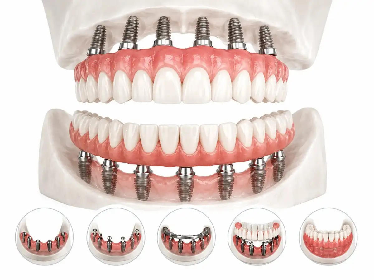 Full mouth dental implants Gurgaon