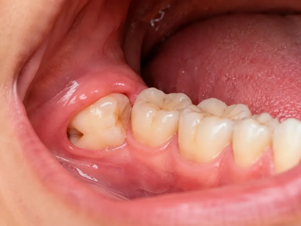 Impacted Wisdom Teeth
