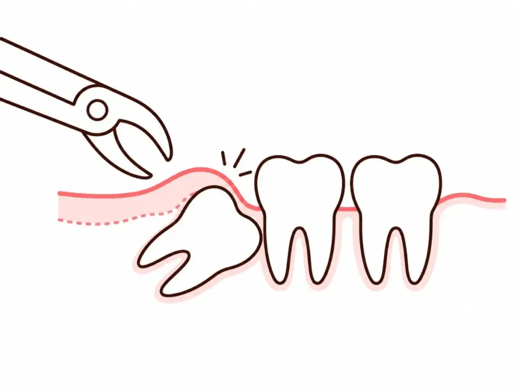 Impacted WisdomTooth Surgeon in gurgaon