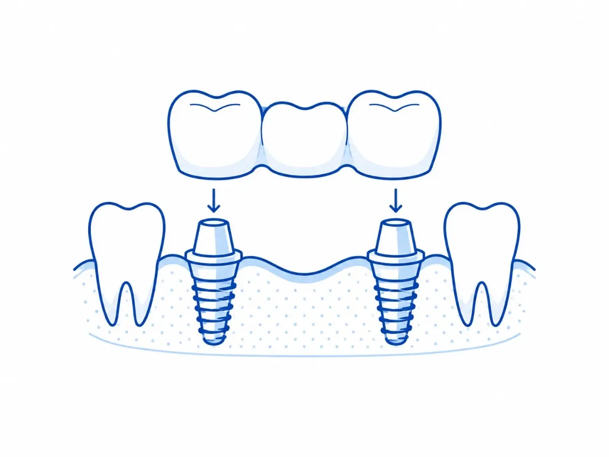 Implant-Supported Bridge