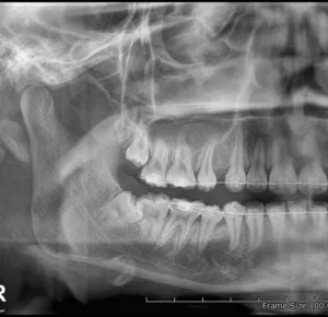 Wisdom tooth