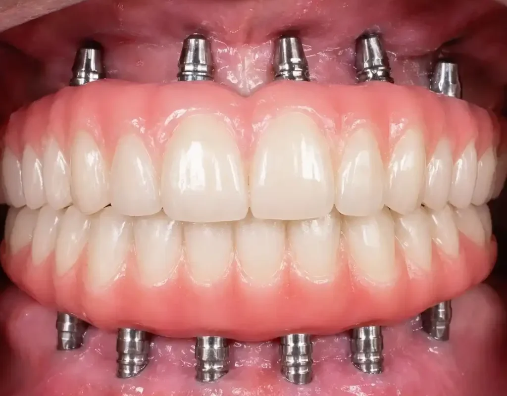 Full Mouth