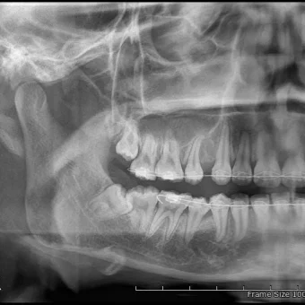 Wisdom tooth