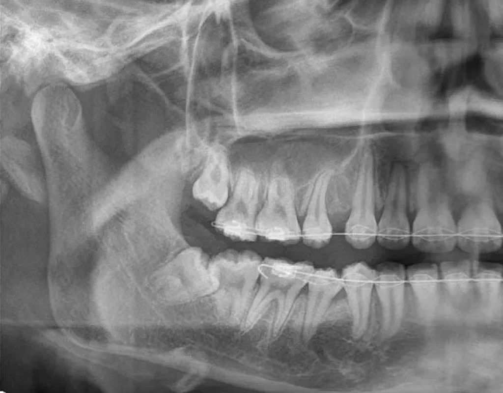 Wisdom tooth