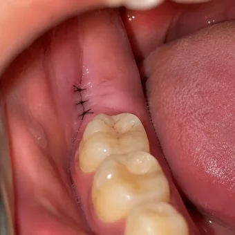 wisdom teeth extraction