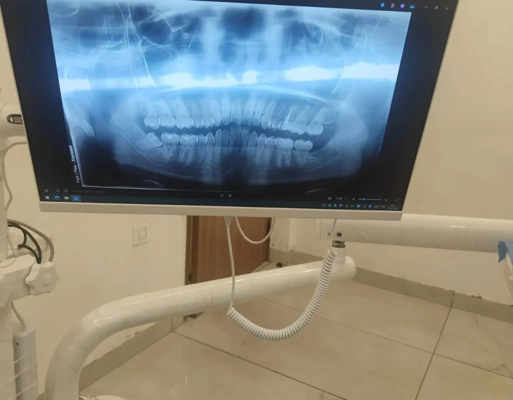 wisdom tooth extraction