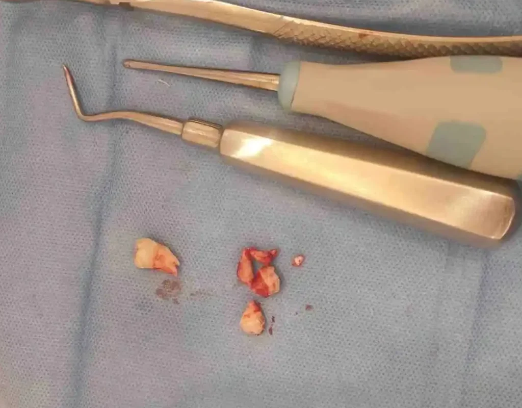 wisdom tooth extraction